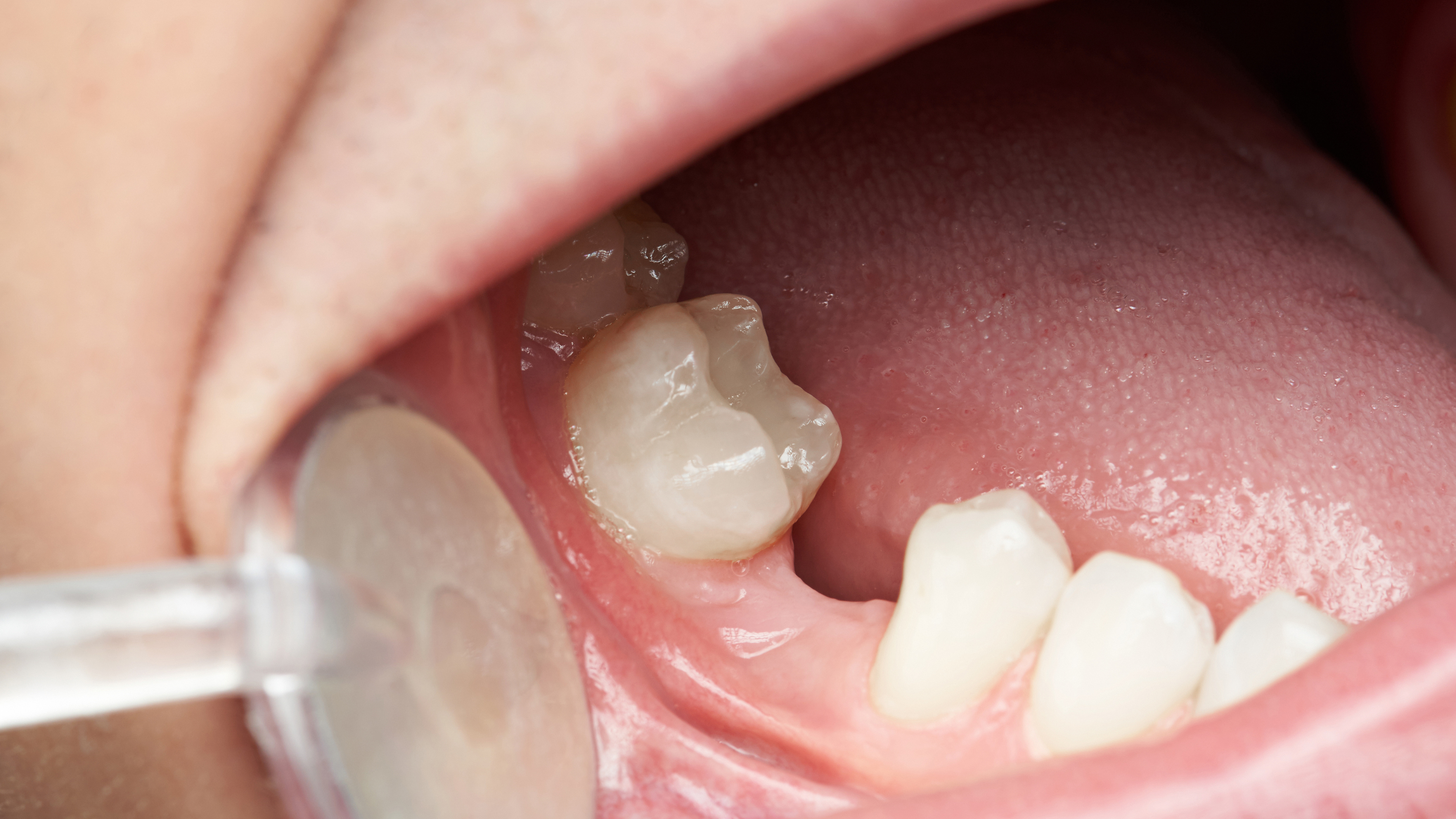Dente Mancante
